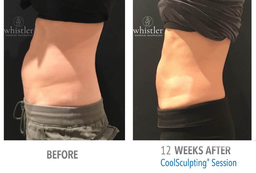 Female-side-abdominal-view-CS-1024x691