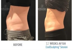 Female-side-abdominal-view-CS-300x203