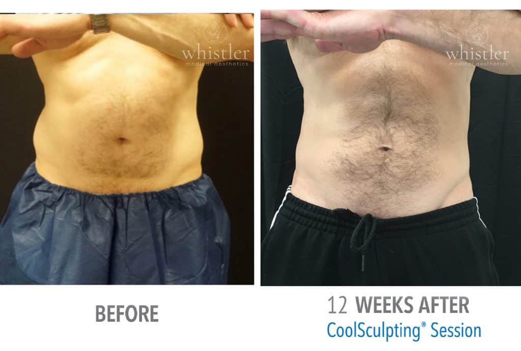 Male-abs-web-before-after-1024x691-1