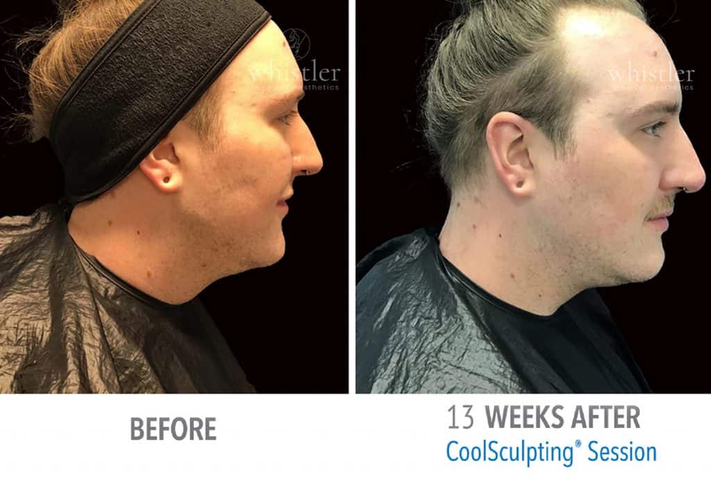 Max-chin-web-before-after-1024x691