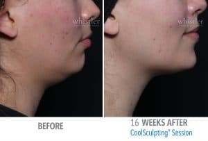 Melissa-Chin-web-before-after-300x203