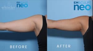 NEO-ARMS-FRONT-BEFORE-AND-AFTER-300x167