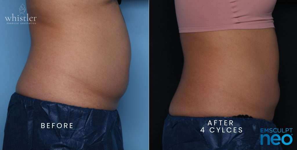 NEO-BEFORE-AFTER-FEMALE-SIDE-VIEW-JAN-22-1024x517