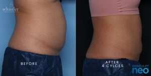 NEO-BEFORE-AFTER-FEMALE-SIDE-VIEW-JAN-22-300x152