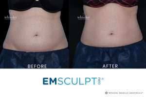 NEo-Female-before-after-Jan-2022-2jpg-300x200