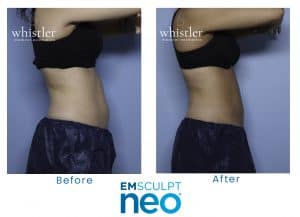 Neo-before-after-1-300x217