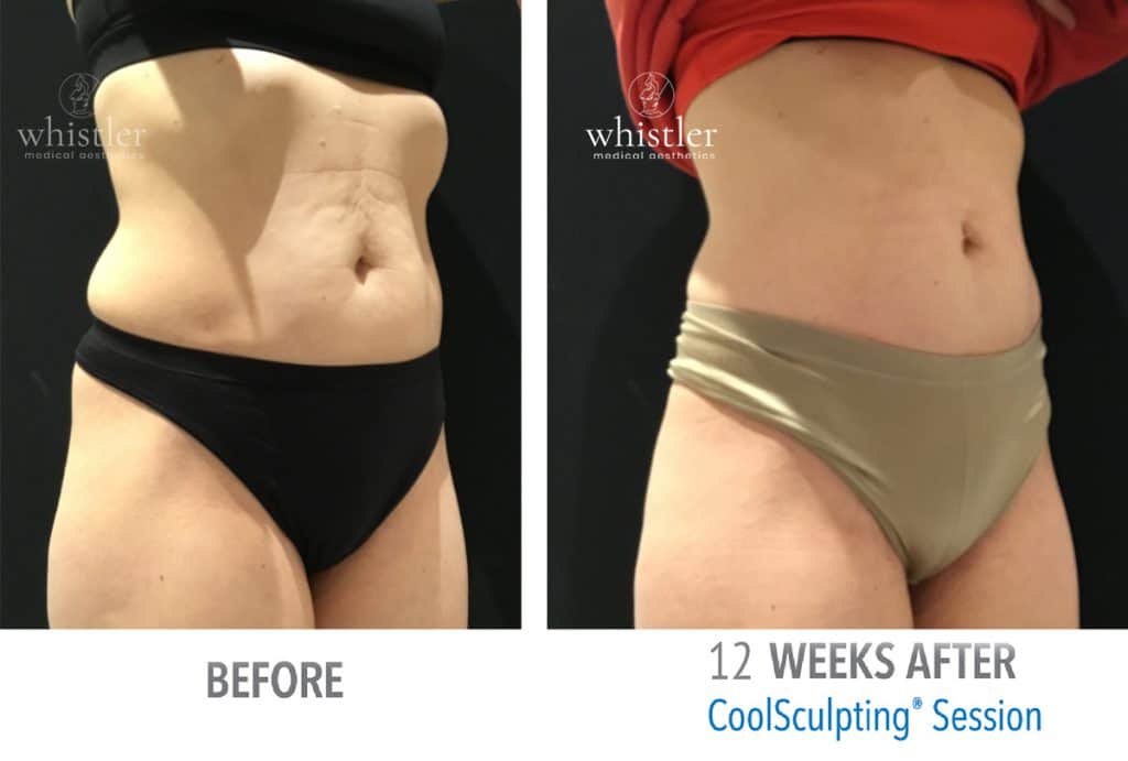 Side-45-female-with-skin-toning-1024x691