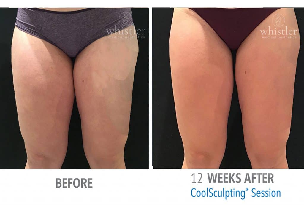 Thighs-2-web-before-after-1024x691