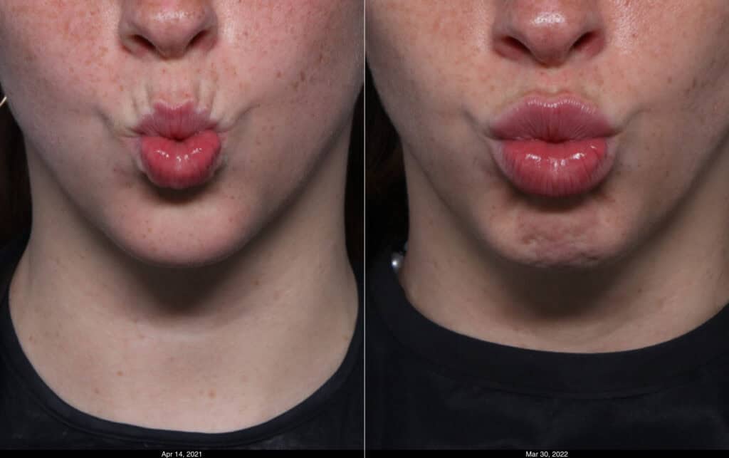 Lip Lines full face before and after