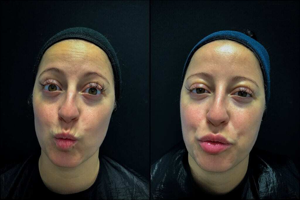Lip Lines before and after