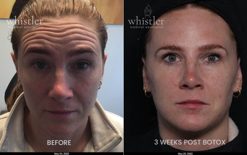Why botox is so popular a botox before and after