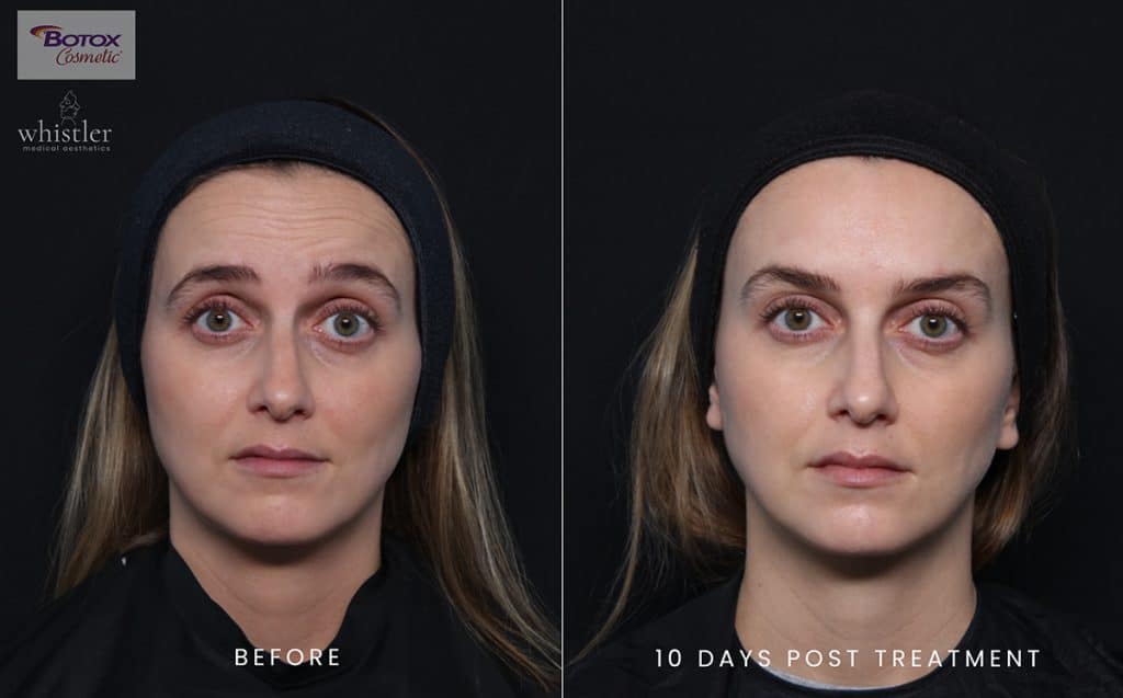 botox before and after why botox is so popular
