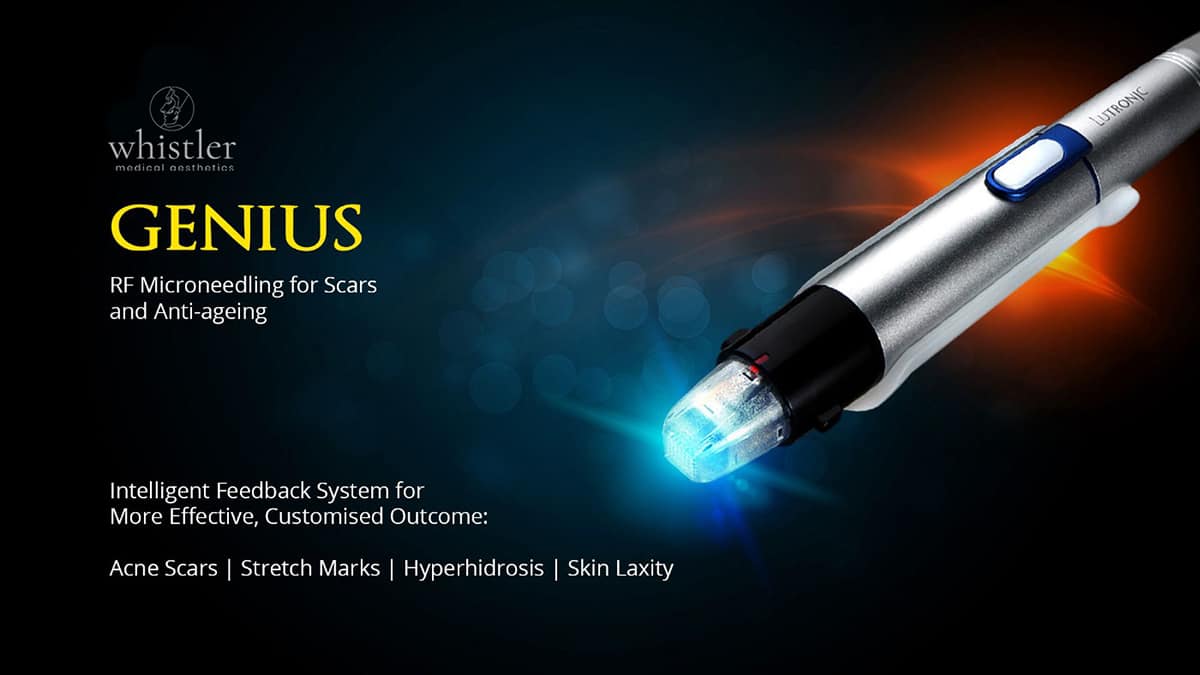 Genius® RF – Radio Frequency Microneedling with Artificial Intelligence