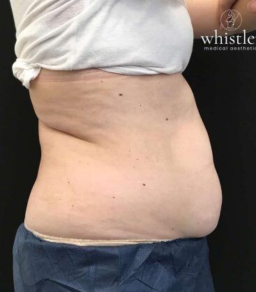 before treatment
