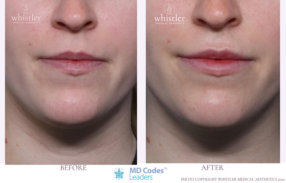 Lips with Dermal Fillers