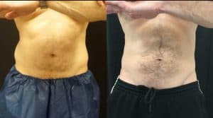 Male-before-after-coolsculpting