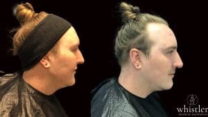 Max-before-and-after-right-facing