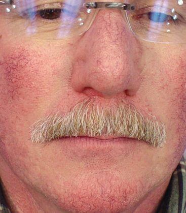 before treatment