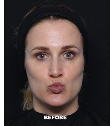 before treatment