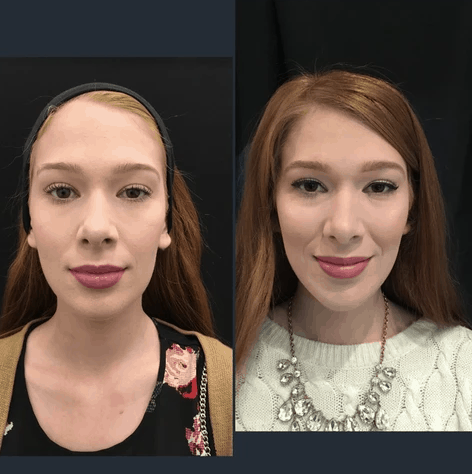 MJ Facial Profile Before and After
