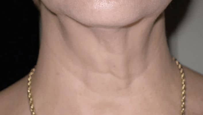 Z-Wave Pro Treatment After