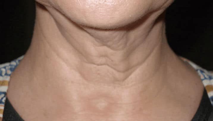 Z-Wave Pro Treatment Before