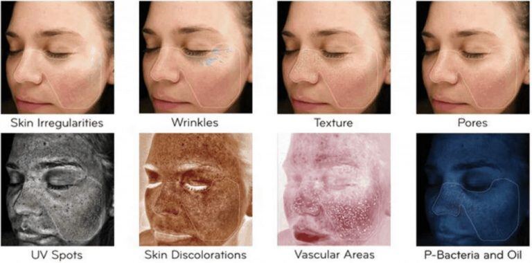 Visia Skin Analysis Scans