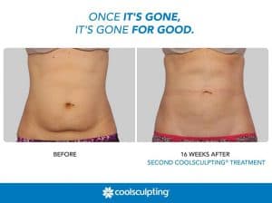 Coolscupting