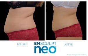 before-after-Neo-red-pants-300x191