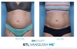 before-after-Vanquish-emsculpt-front-300x191