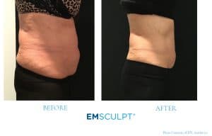 before-after-emsculpt-side-300x192