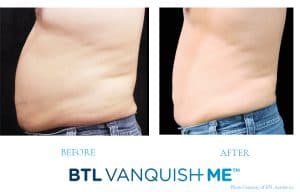 before-after-male-vanquish-300x192