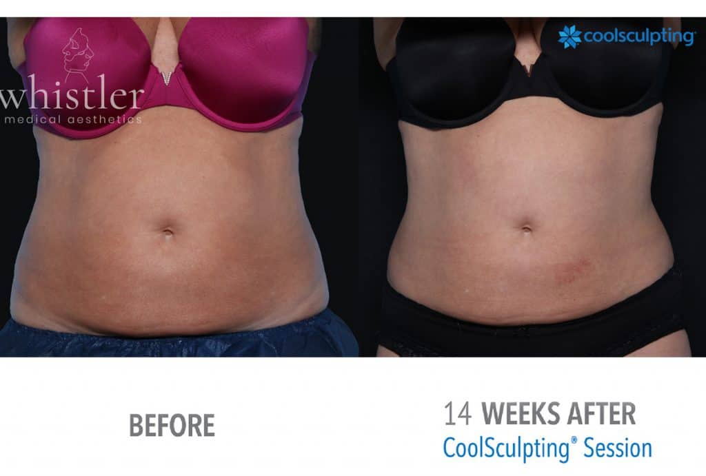 coolsculpting-before-after-Fem-jan-222-front-1024x691