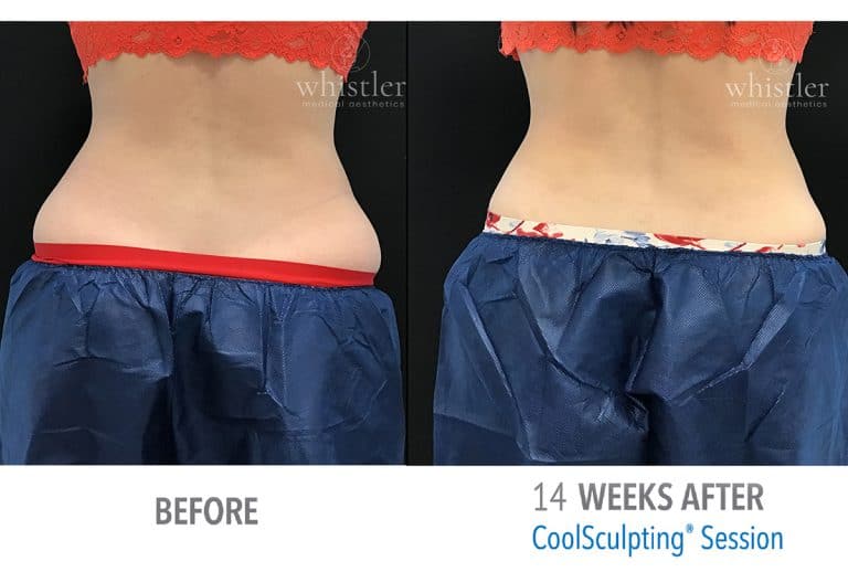 Coolsculpting Before & after 9