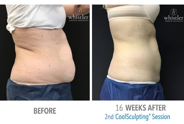 Coolsculpting Before & after 1