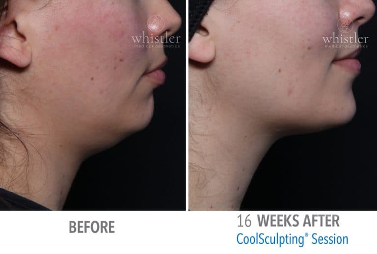 Coolsculpting Before & after 10