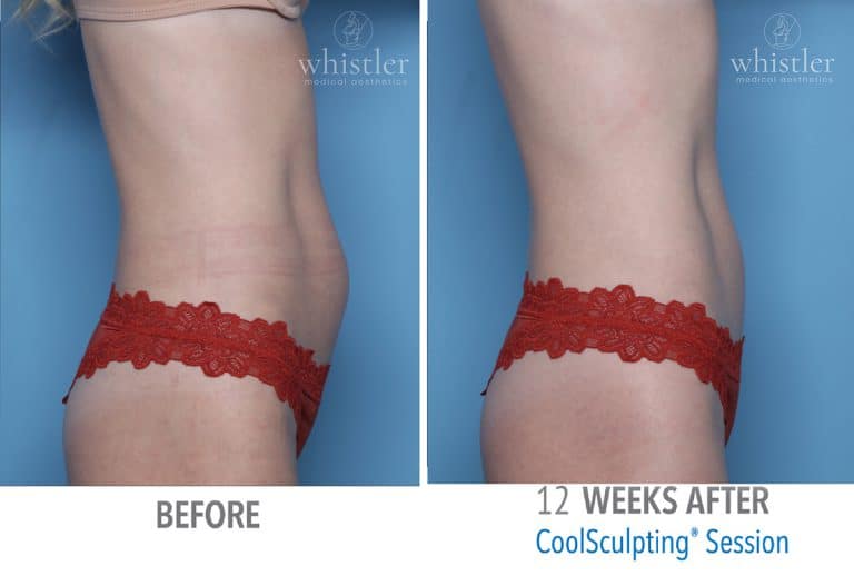 Coolsculpting Before & after 4