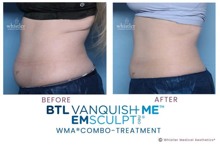 Abdominal ft treatment with Vanquish and Neo