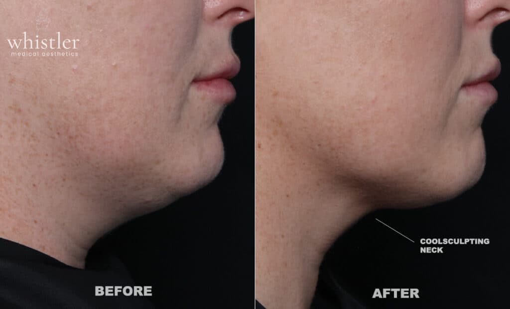 coolsculpting under chin