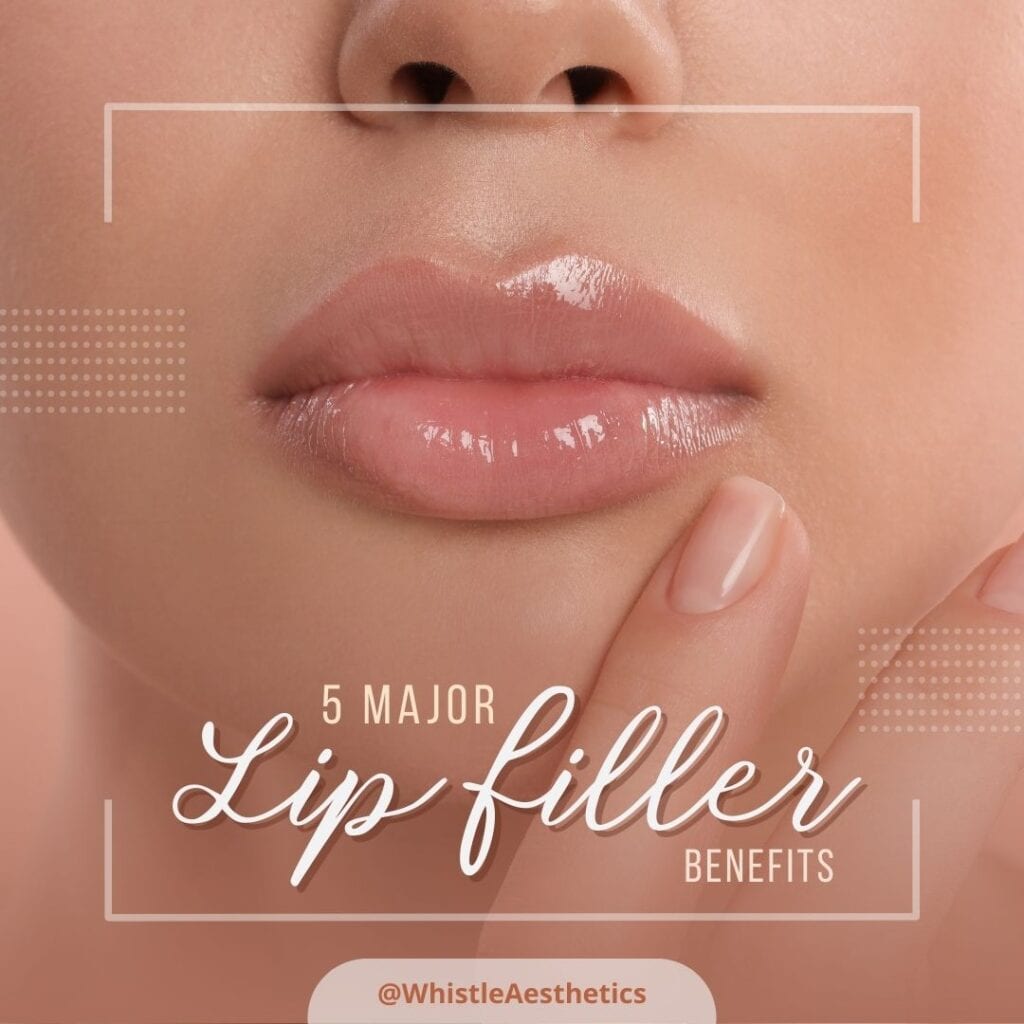 5 Major Lip Filler Benefits