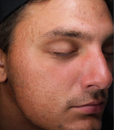 Male acne Before