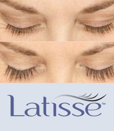 Latisse Before and After 1