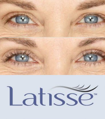 Latisse Before and After 2